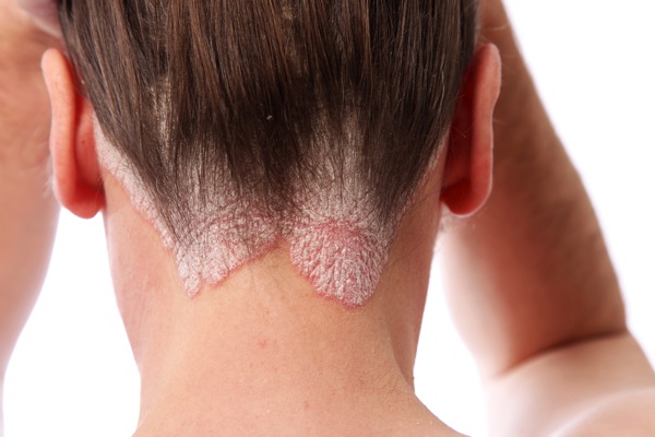 Scalp and neck Psoriasis