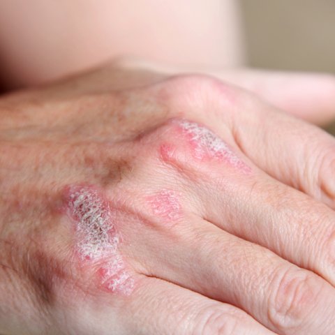 Psoriasis on hand bone