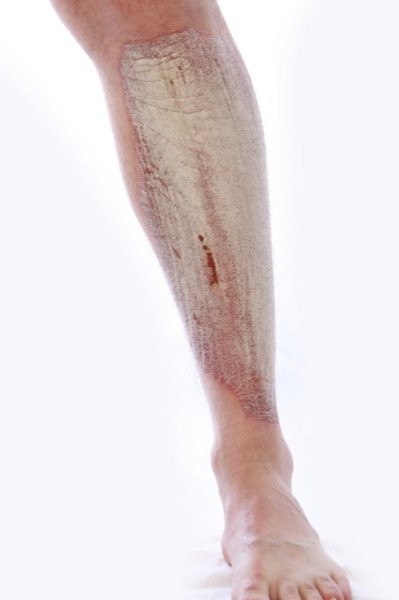 Psoriasis en la pierna